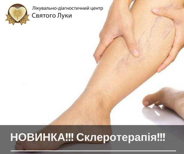 Склеротерапія. Франківців інформують про безболісне лікування варикозу