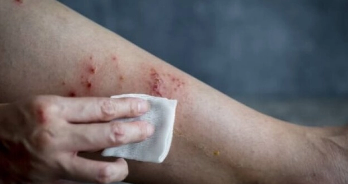 В Україні зафіксували перший випадок мавпячої віспи