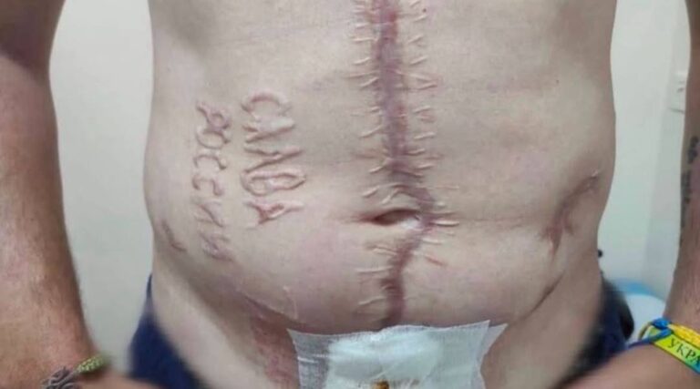 У ГУР підтвердили справжність фото із написом “Слава Росії” на тілі військового, який повернувся з полону