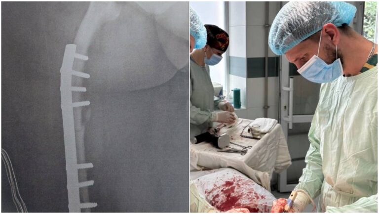 У Франківську провели операцію пацієнтці з рідкісними захворюваннями опорно-рухового апарату